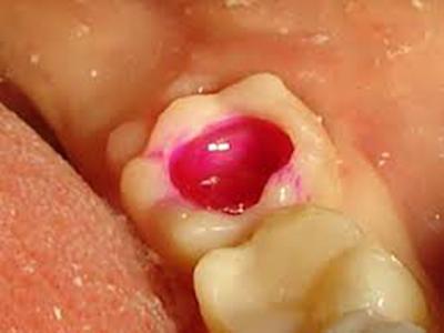 Глибокий карієс за МКБ 10, його симптоми, скарги і болю, дуже болить зуб при хронічному випадку, що це таке