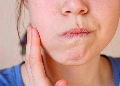 Фурацилін від стоматиту у дітей і дорослих: засіб для полоскання рота і лікування захворювання
