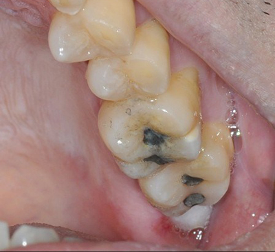 Етапи лікування карієсу зубів, опис алгоритму поетапно