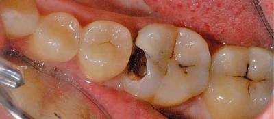 Пульпіт зуба: що це таке, як лікувати у дорослих лазером, лікується, як вилікувати в домашніх умовах, який кладуть ліки