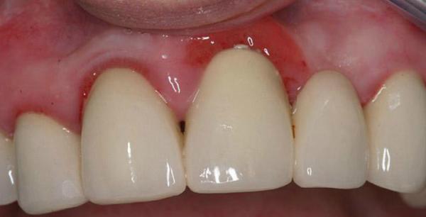 Множинний карієс: що робити, якщо багато уражених ділянок, чому не можна зволікати з лікуванням, як роблять чистку на всіх зубах