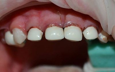 Пульпіт хронічний і гострий: МКБ 10, що це таке, симптоми, лікування, скарги, загострення, EDI, диференціальна діагностика зуба