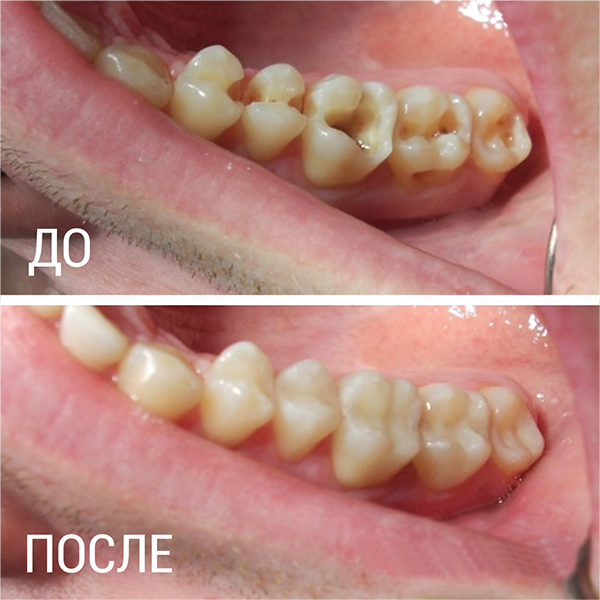 Карієс, пульпіт, депульпованого зуба, вторинний глибокий ускладнений періодонтит, МКБ 10, що таке гіперемія пульпи, лікування