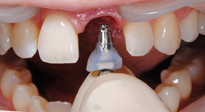 Експрес імплантація зубів: через скільки після видалення можна одночасно ставити імплант, коли по часу, відразу установка