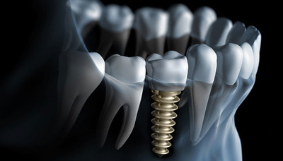 Імплантація зубів під загальним наркозом, потрібна премедикація перед операцією внутрішньовенно
