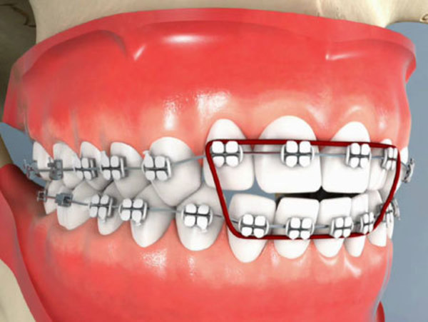 Еластики для брекетів: види гумок, як надягати тяги на зуби, для чого потрібні гумки, скільки носити, фото того, як одягати