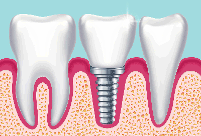 Боляче ставити імплант зуба, що таке зубна імплантація, скільки днів болить і як її робити: вставляти або вкручувати?