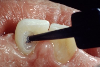Відбілювання зубів opalescence: система опалесценс буст, домашнє boost xtra з капами, що це таке