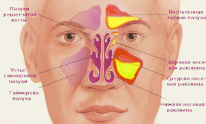 Як позбутися від закладеності носа без нежиті?