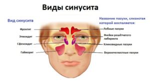 Лікування одонтогенного верхньощелепного синуситу