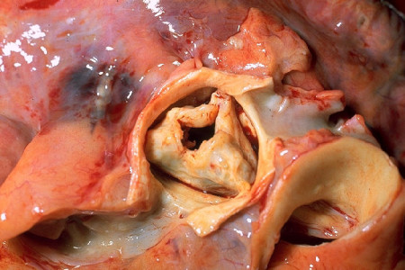 Діагностика і методи лікування стенозу аортального клапана