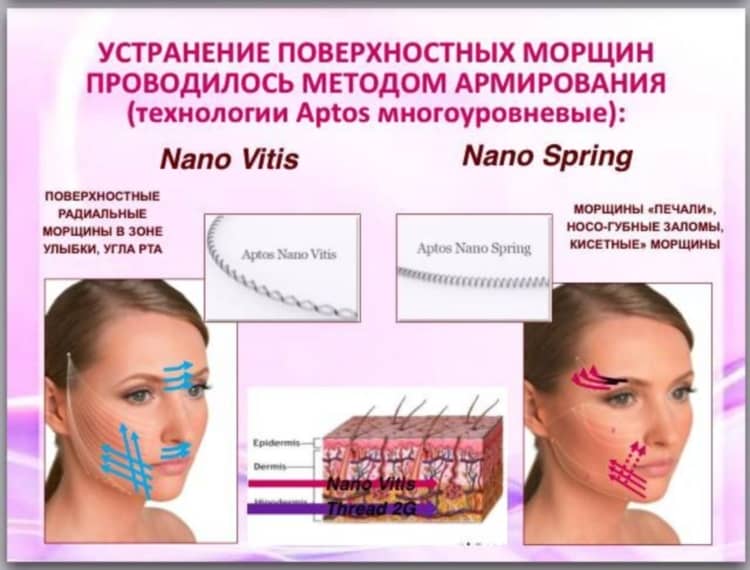 Один з ефективних методів підтримки молодості і краси — нитки АПТОС для підтяжки обличчя, їх види та відгуки про процедуру