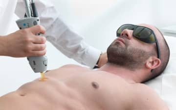 Лазерна епіляція для чоловіків — сучасний метод проти застарілої боротьби із зайвими волоссям