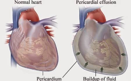 Що означає розширення серця вліво?