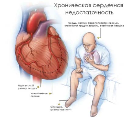 Лікування і профілактика недостатності серця в хронічній формі
