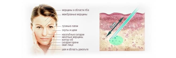 Біоревіталізація гіалуронової кислотою: що це таке, фото до і після і відгуки про уколах краси і молодості