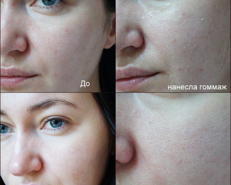 Гоммаж для обличчя і тіла — що це таке і як ніжно і без тривалого відновного періоду очистити шкіру