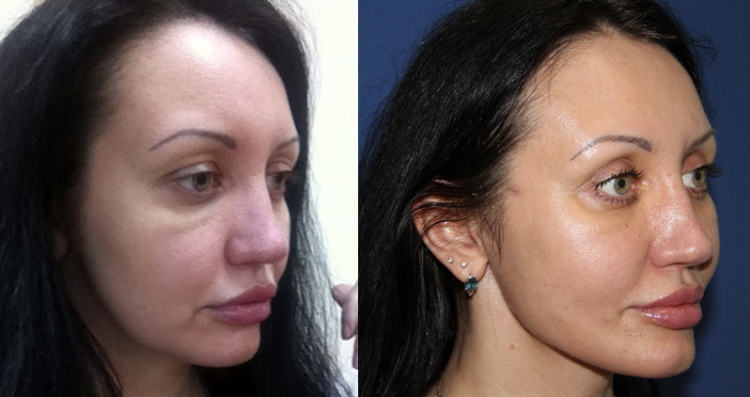 Один з ефективних методів підтримки молодості і краси — нитки АПТОС для підтяжки обличчя, їх види та відгуки про процедуру