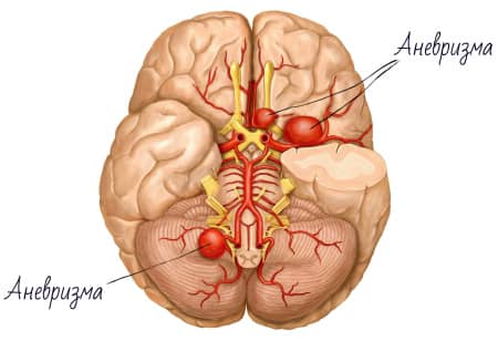 Що потрібно знати про аневризми судин головного мозку