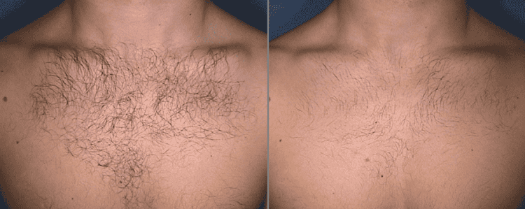 Лазерна епіляція для чоловіків — сучасний метод проти застарілої боротьби із зайвими волоссям