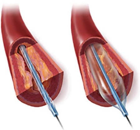 Стентування, як сучасний і ефективний метод ендоваскулярної хірургії
