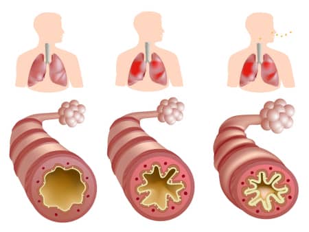 Діагностика і методи лікування стенозу гирла легеневої артерії