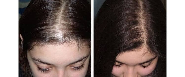 Лікувальний вплив і приголомшуючий ефект процедури дарсонвалізації волосся