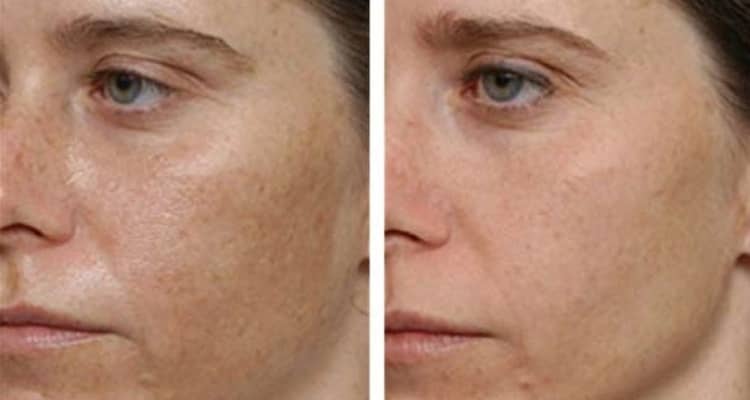Процес оновлення шкіри обличчя за допомогою хімічного пілінгу — відгуки, як працює і для чого потрібно