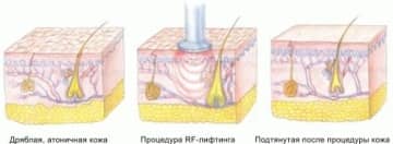 RF ліфтинг тіла: що це таке і як зробити підтяжку без операційного втручання і шрамів