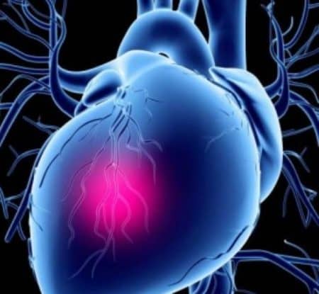 Історія розвитку хвороби інфаркту міокарда