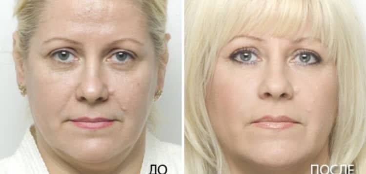 Відновлення й омолодження шкіри особи з допомогою плазмолифтинга, відгуки, фото до і після сеансів