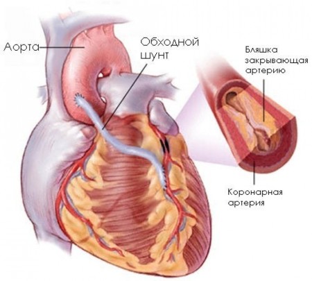 Шунтування – операція на серці