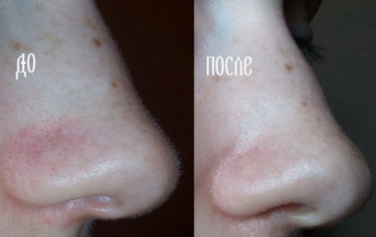 Маска плівка для обличчя — відмінний спосіб чищення, який додатково живить шкіру і звужує пори