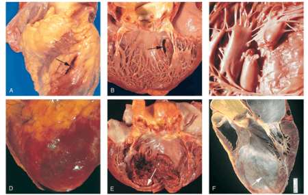 Синдром гострого інфаркту міокарда та особливості його діагностики
