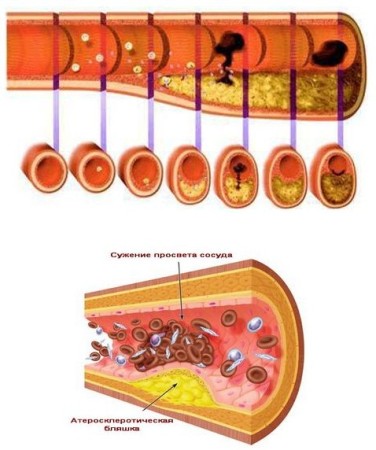 Причини виникнення і лікування атеросклерозу аорти