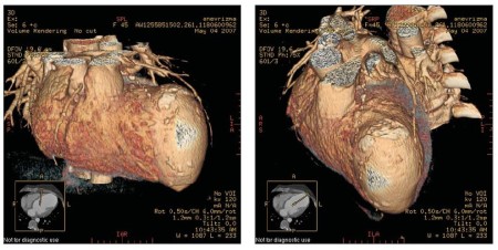 Серцева аневризма як ускладнення інфаркту міокарда