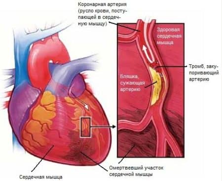 Симптоми, лікування, профілактика інфаркту міокарда