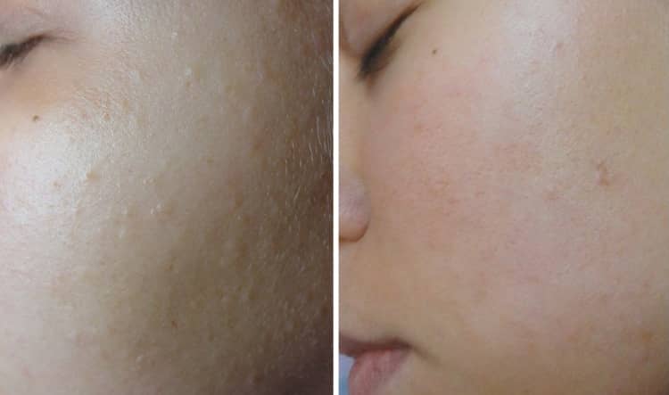 Ультразвукова чистка обличчя — висока ефективність без шкоди для шкіри, відгуки про процедуру