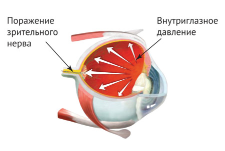 Причини та ознаки очного тиску