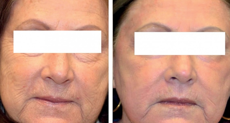 Як виконується глибокий хімічний пілінг обличчя, плюси і мінуси, фото до і після процедури