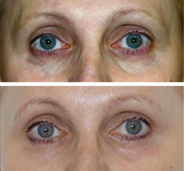 Відновлення й омолодження шкіри особи з допомогою плазмолифтинга, відгуки, фото до і після сеансів