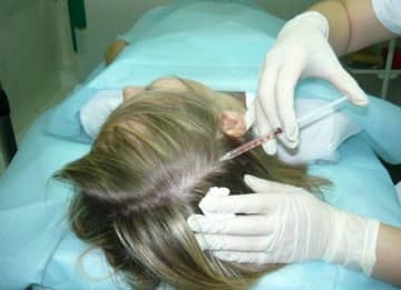 Що таке мезотерапія волосистої частини голови і як це допомагає прекрасній половині людства