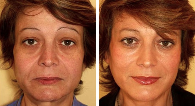 Стек гілок ліфтинг шкіри обличчя — плюси і мінуси ефективної процедури омолодження