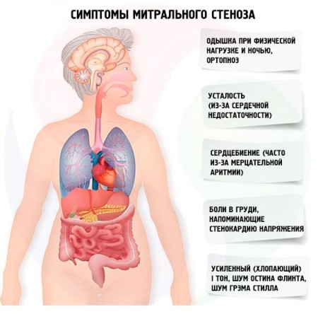 Симптоми та особливості лікування стенозу мітрального клапана