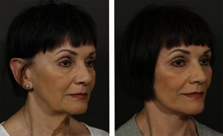 Ефективність, результати та переваги підтяжки шкіри золотими нитками для особи, фото до і після процедури