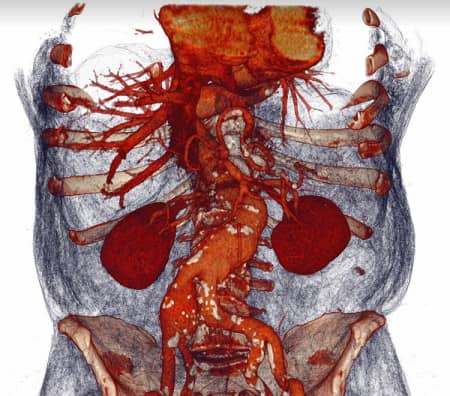 Діагностика і лікування атеросклерозу черевного відділу аорти