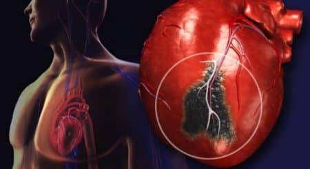 Синдром гострого інфаркту міокарда та особливості його діагностики