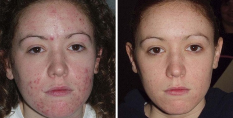 Ультразвукова чистка обличчя — висока ефективність без шкоди для шкіри, відгуки про процедуру