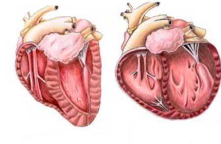 Що означає розширення серця вліво?
