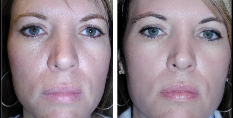 Гліколевий пілінг обличчя — що це таке, плюси і мінуси салонної процедури